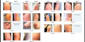 Efectos por vacuna contra COVID-19 afecta más a mujeres; la mayoría no son graves