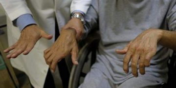 Faltan programas; desatienden artritis en México